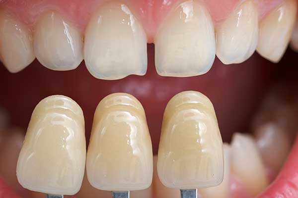 Cosmetic Bonding showing teeth