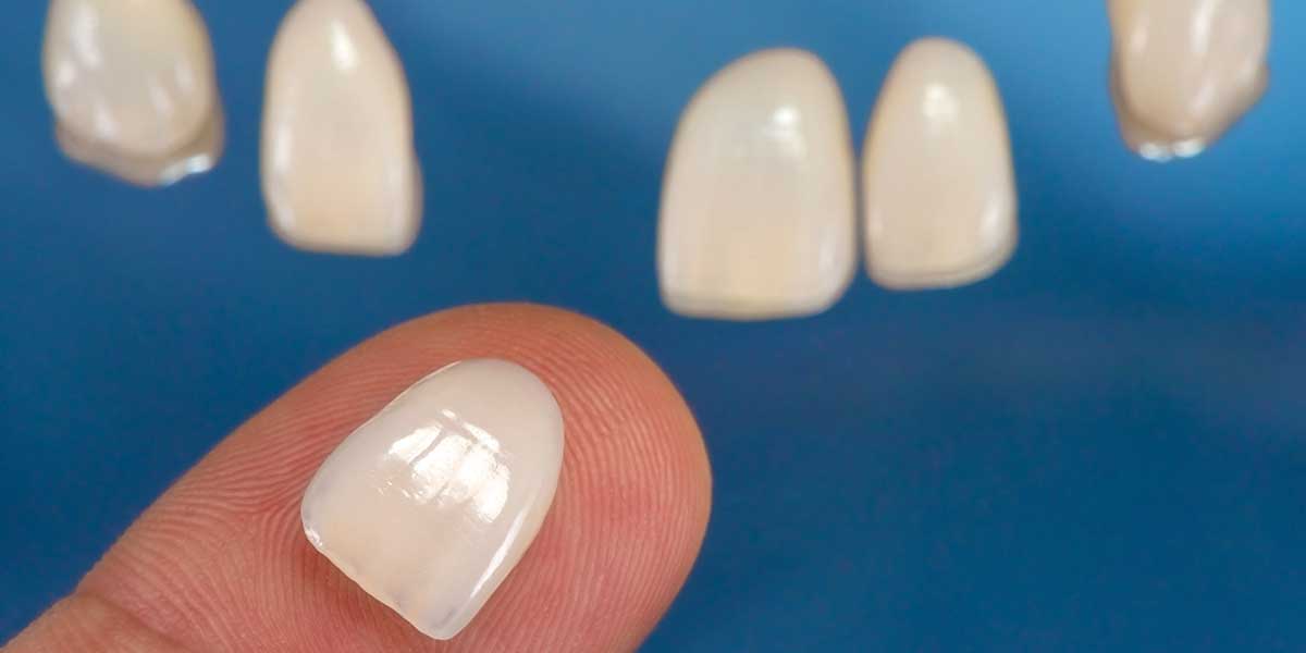 dental veneers
