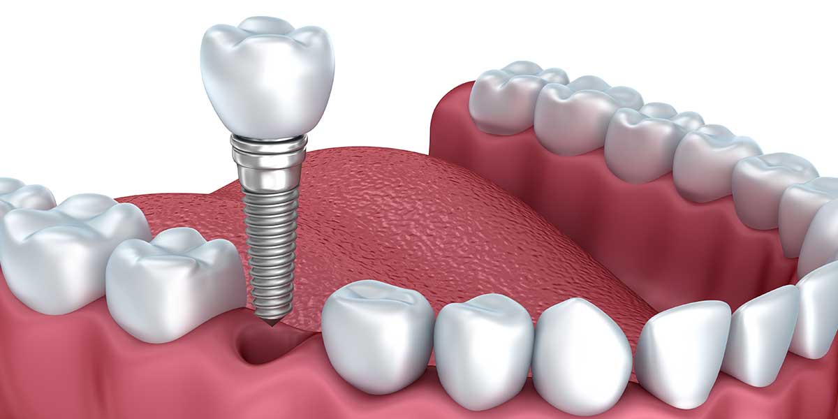 implant single tooth