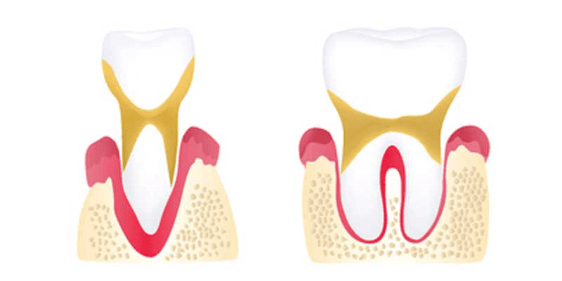 tooth graphic advanced periodontitis