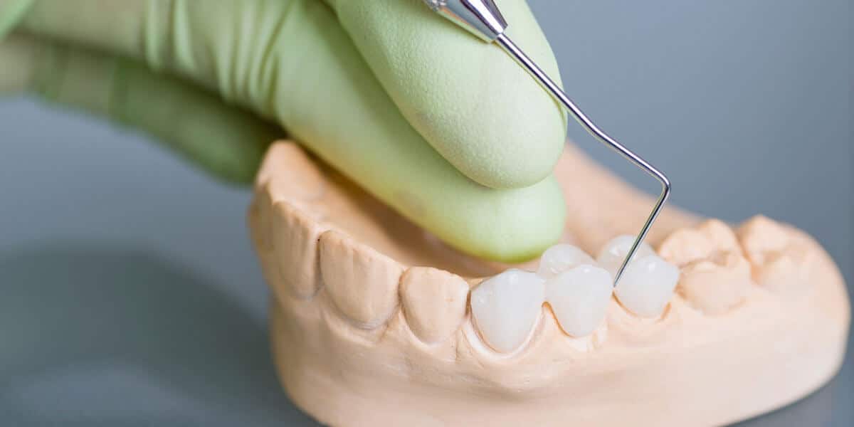 dental bridge