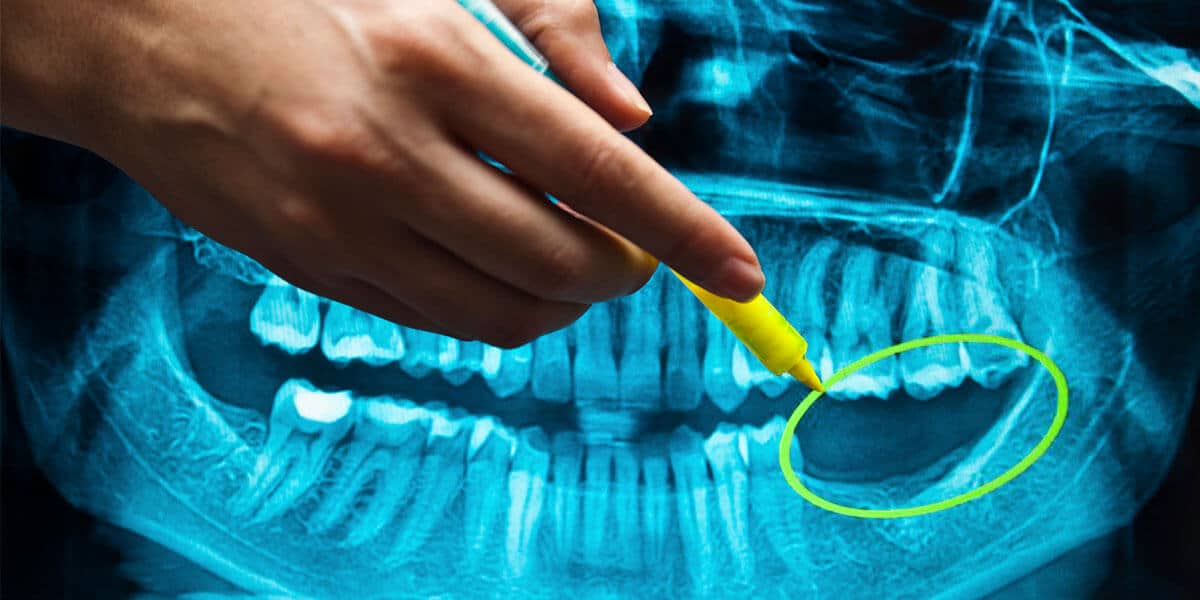 xray dental implant
