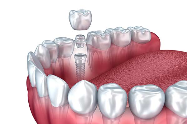 dental implants