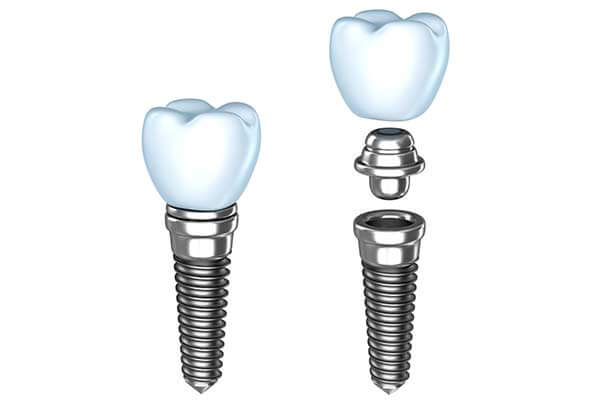 dental implant graphic