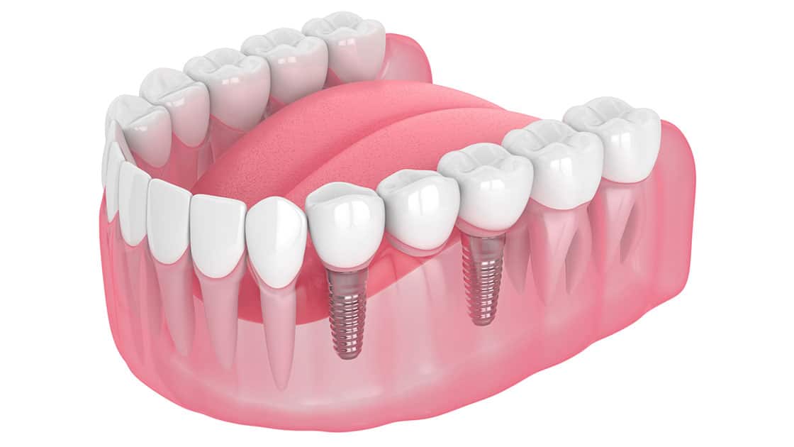 Implant supported bridge illustration