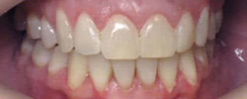 invisalign-after