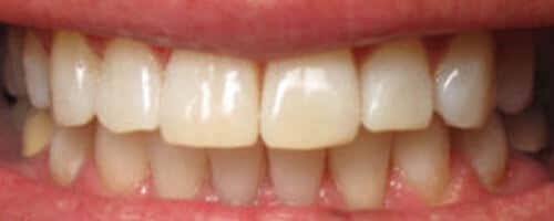 invisalign after picture