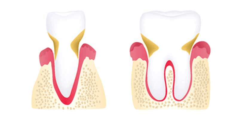 tooth graphic periodontitis