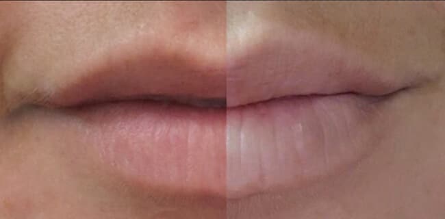 lip enhance photo