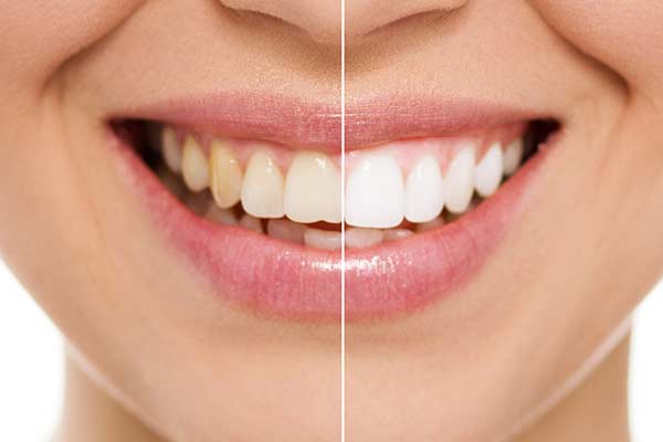 teeth whitening smile